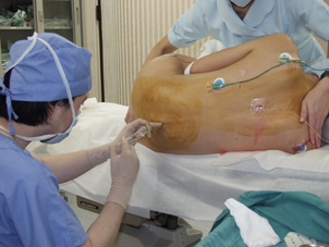 脂肪吸引の手術写真