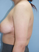 脂肪吸引の症例写真