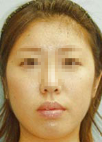 頬の脂肪吸引